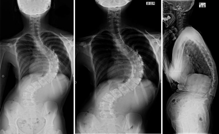 側弯症外来 背骨のゆがみ まがり 西宮市や芦屋市 くらかわ整形外科 耳鼻咽喉科