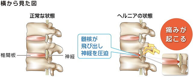 椎間板ヘルニアとは