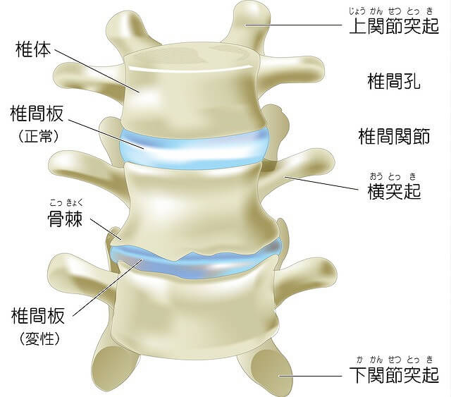 と 椎間板 は ヘルニア