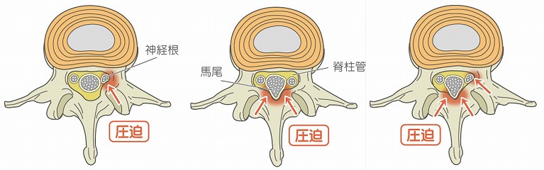 腰部脊柱管狭窄症とは